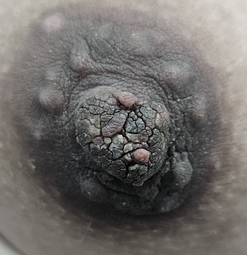 Hyperkeratosis of nipple with two additional skin tags at 1:00 and 4:00